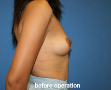 plastic-surgery-breast-augmentation